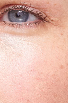 Dark spots intensity